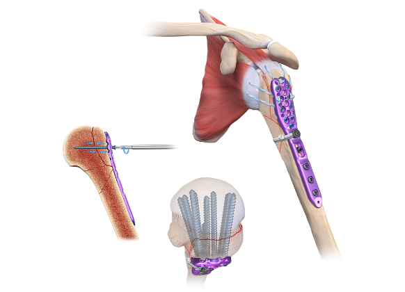 Ryo Arthrex - FxBridge Tuberosity Repair System - AR-9517